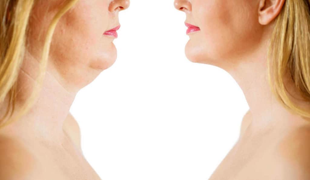 Double Chin treatment Newmarket before and after results