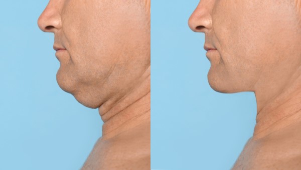 Which Non-Surgical Treatments Work Best for Jowls and Loose Skin Newmarket?