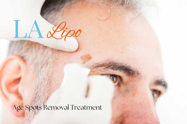 What Are the Most Effective Treatments for Age Spots Newmarket?