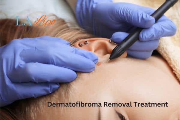 Dermatofibroma Removal Treatment Newmarket