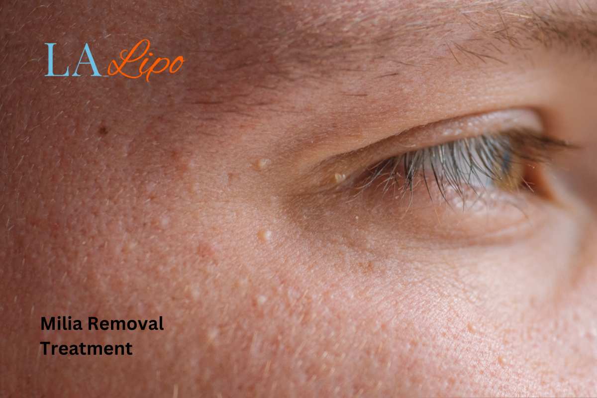Cryopen Milia Removal: Is It the Easiest and Safest Option Newmarket?