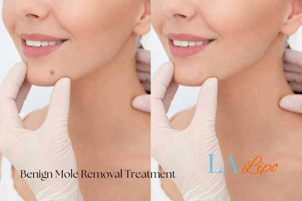 Before and after mole removal Newmarket treatment