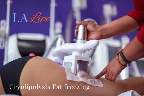 women getting fat freezing Newmarket