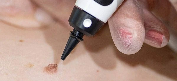 skin tag removal using cryopen Newmarket