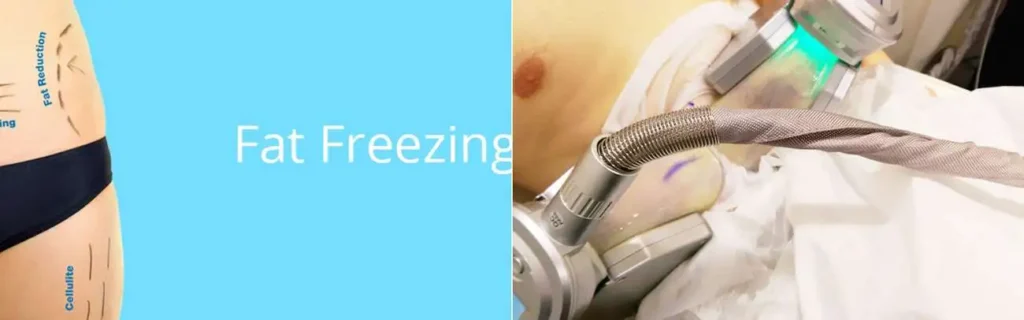 Fat freezing Newmarket on multiple areas of the body
