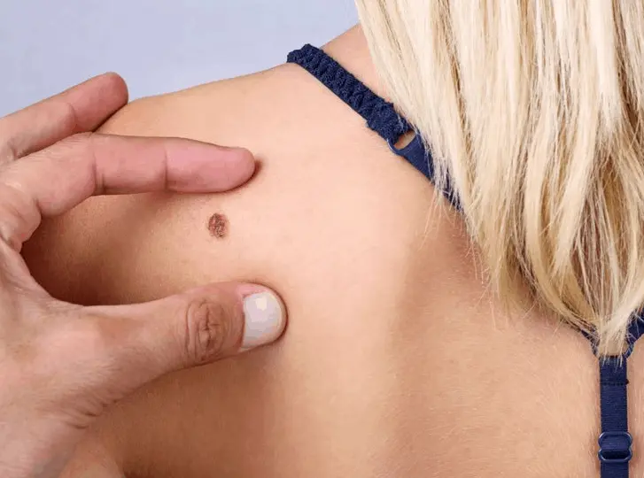 woman having mole removal Newmarket consultation before treatment.