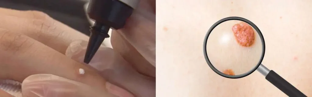 Cryopen for mole removal Newmarket - speak to our team today!