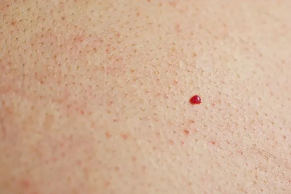 close up of a cherry angioma Newmarket