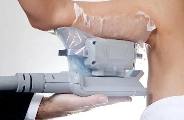 Picture of fat freezing Newmarket on the upper arms.