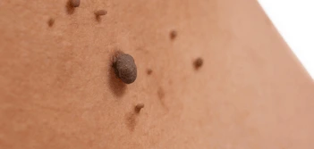 image of a skin tag Newmarket