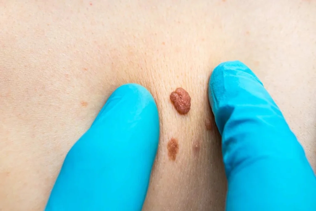 Consultant examining a skin tag Newmarket