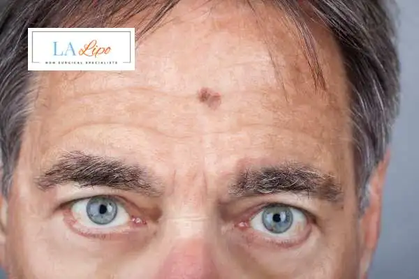 Solar Lentigo Removal Newmarket image of man with mark on his forehead