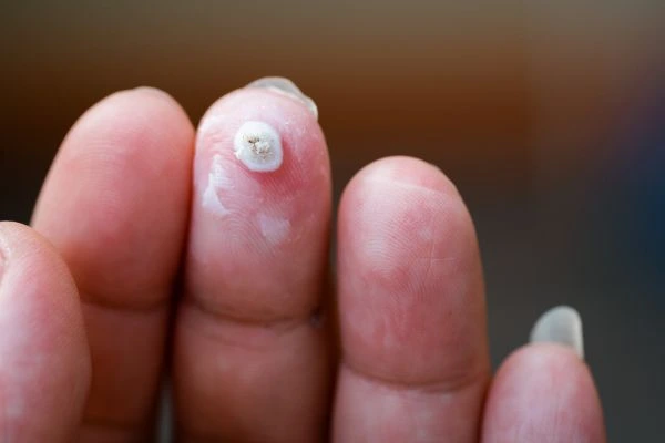 wart on person finger - cryotherapy to treat from LA LIPO Newmarket