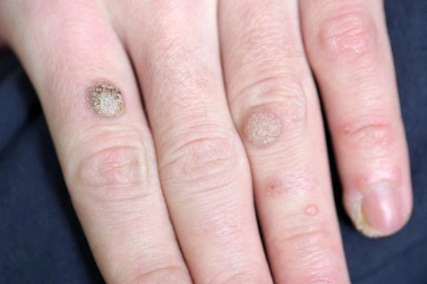 photo of warts on person hand - see wart removal Newmarket from LA LIPO