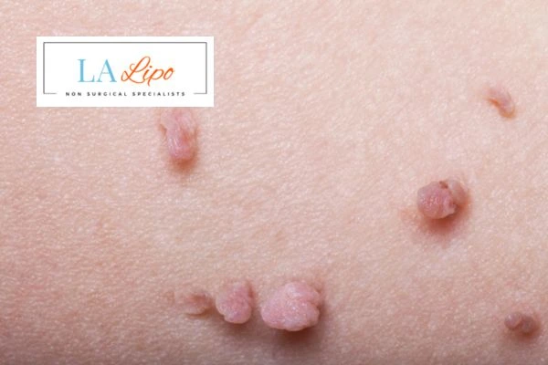 Does cryopen skin tag removal Newmarket hurt? Find out now call our team today!