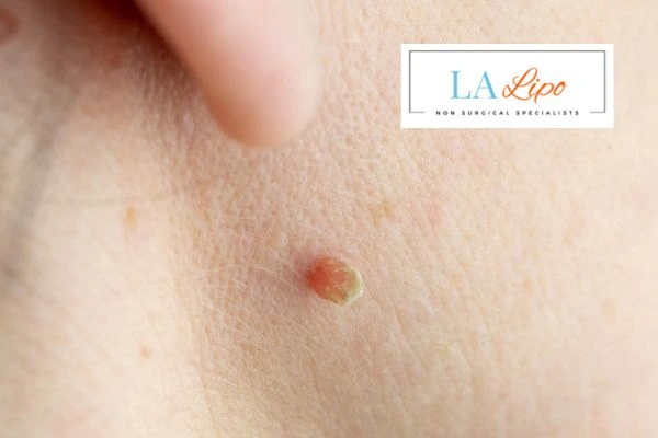 Book skin tag removal Newmarket today speak to our team now!