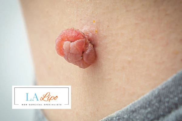 Interested in skin tag removal Newmarket? Concerned about the pain? Find out more today!
