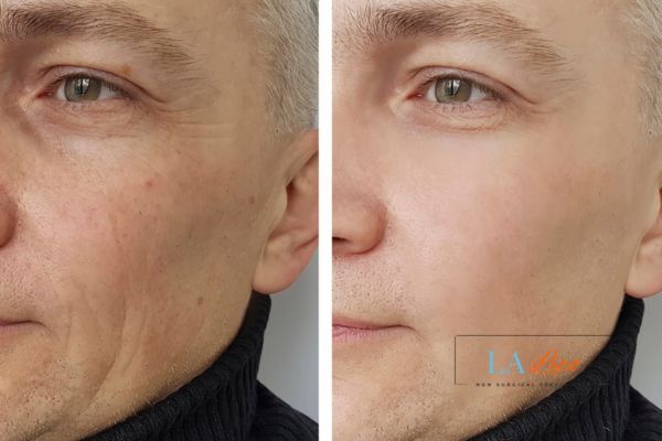 See the amazing results of Morpheus8 Treatment Newmarket!