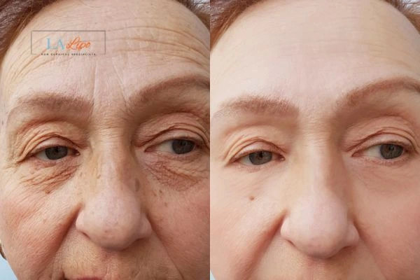 The powerful benefits of Morpheus8 Treatment Newmarket - Call Our team today!