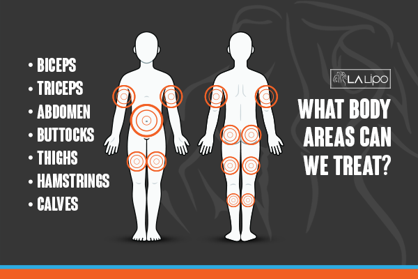 Diagram to show areas you can have LA-EMS Body Sculpting Treatment Newmarket