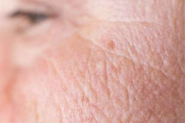 close up picture of a woman's face showing an age spot Newmarket