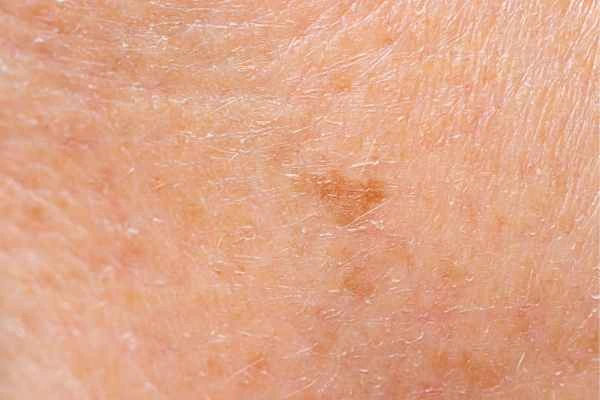 close up picture of age spots Newmarket