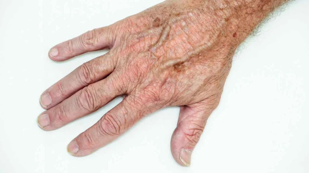 Male hand showing age spot Newmarket