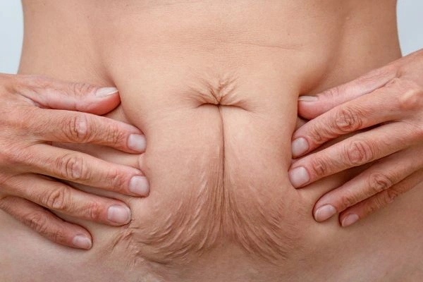 Image of a woman's stomach with loose skin - example of skin tightening Newmarket options