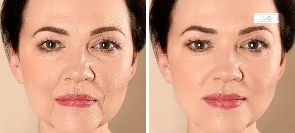 How Long Does It Take to See Results and How Long Do They Last Newmarket?