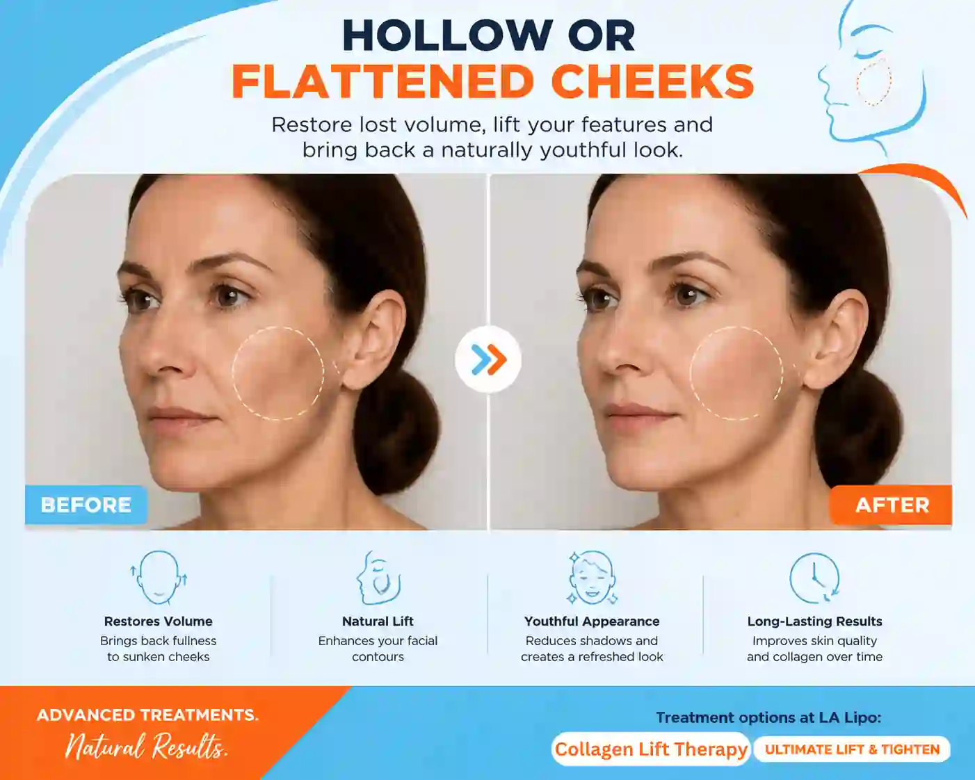 Sign #4: Hollow or Flattened Cheeks Newmarket