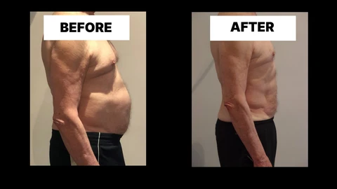 What Symptoms Can Diastasis Recti Cause in Men? Weak Core, Back Pain and Poor Posture Newmarket